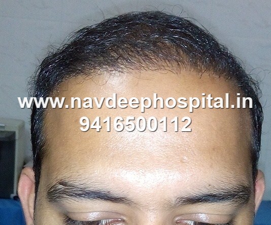 5 months after FUE hair transplant at Navdeep hospital and hair transplant center, Panipat, Haryana, India.