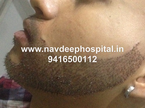 Immediately after FUE hair transplant for beard at Navdeep hair hospital and laser center, Panipat, Haryana, India