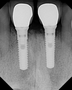 Best Dental implant by Dr Marrilin Gupta, BDS, MDS Prosthodontist Panipat