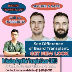 Beard hair transplant