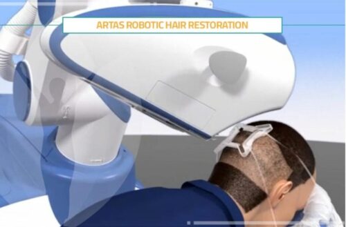 Robotic hair transplant ARTAS Robot