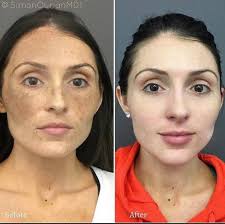 Melasma pigmentation treatment by Chemical peel