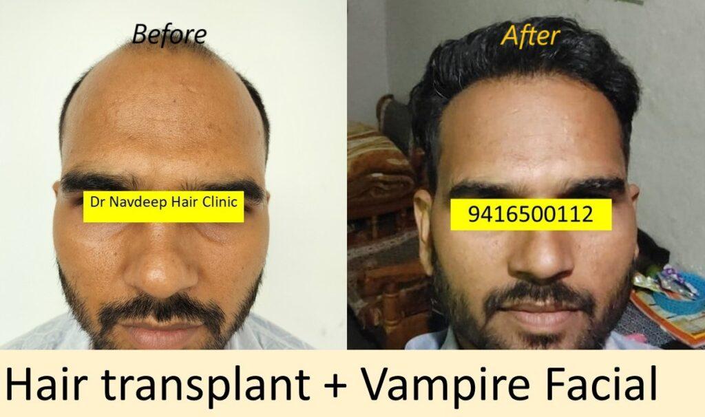 Check out the stunning transformation achieved with our advanced hair transplant, vampire facial, and cosmetic dermatology treatments at Navdeep Hair Transplant & Laser Clinic in Panipat! Our expert team is dedicated to providing natural-looking, rejuvenated hair and skin. WhatsApp +91-9416500112